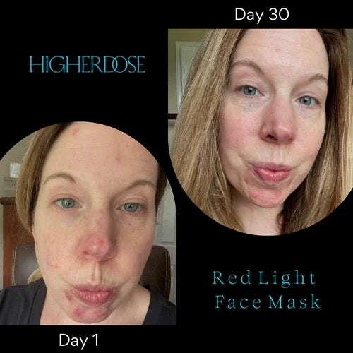 Red Light Therapy for Hyperpigmentation: How Does It Work?